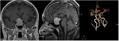 Simultaneous resection of pituitary adenoma and clipping of aneurysm through endoscopic endonasal approach: a case report